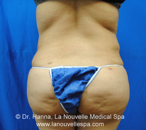 Liposuction Before and After by Dr Hanna, La Nouvelle| Oxnard, Ventura Liposuction Before and After by Dr Hanna, La Nouvelle| Oxnard, Ventura